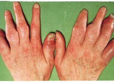 Artrite Psoriásica E Psoríase